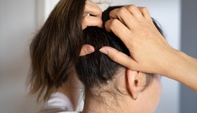 Dermatite seborroica: sintomi, cause, trattamenti