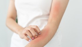 Dermatosi: cos’è e come curarla