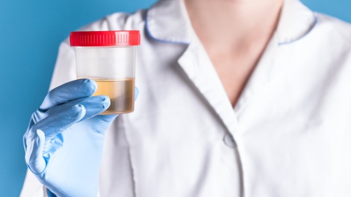 Ematuria (sangue nelle urine): sintomi e cura