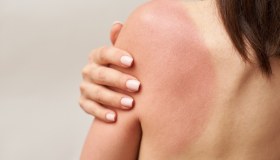 Fotodermatosi: cos’è, sintomi, come curarla