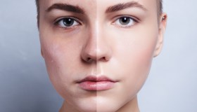 Fotoringiovanimento: cos’è e come avviene il trattamento