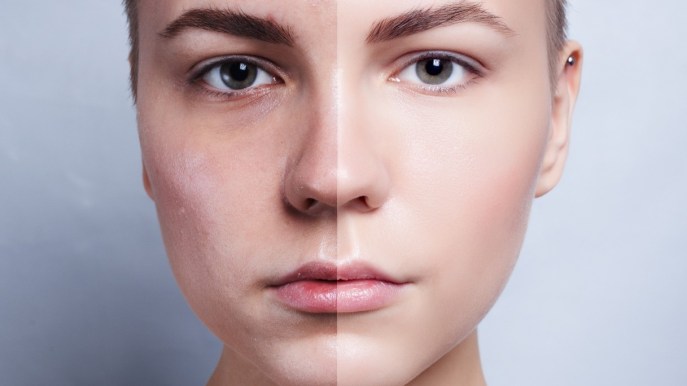 Fotoringiovanimento: cos’è e come avviene il trattamento