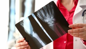 Fratture composte: cosa sono e come si curano