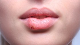 Herpes labbra: cos’è, sintomi, come curarlo
