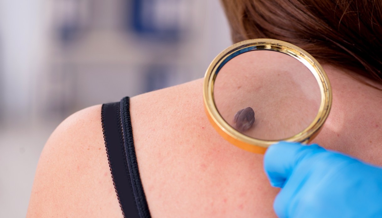Melanoma: cos’è, sintomi, diagnosi, cura