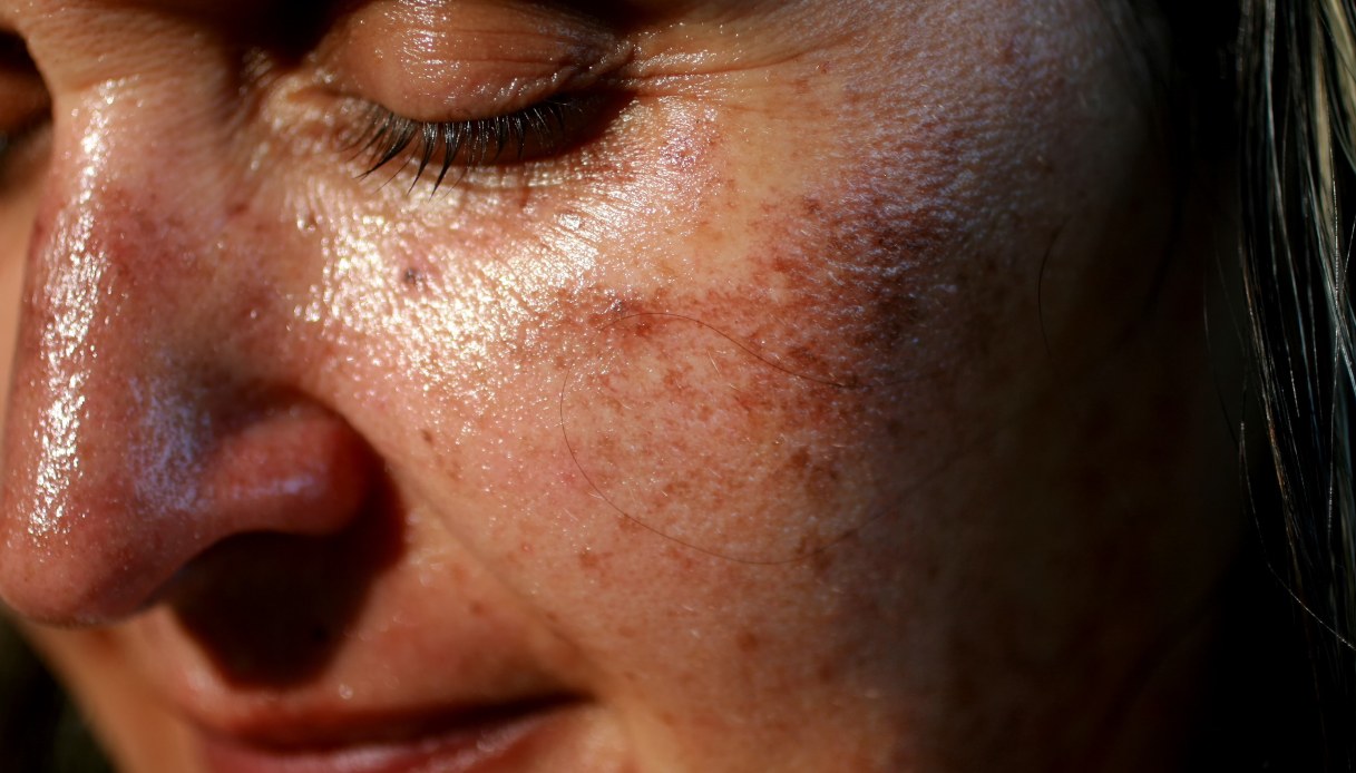 Melasma: sintomi, cause e trattamento