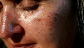 Melasma: sintomi, cause e trattamento