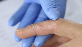 Micosi: cos’è, sintomi e cause