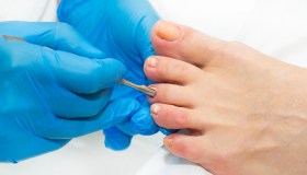 Onicocriptosi (unghia incarnita): cause e cura