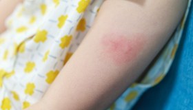 Pitiriasi Rosea (di Gibert): cause, diagnosi e cure