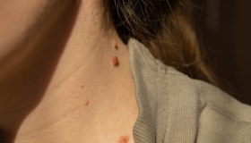 Porri della pelle: cosa sono e come si curano