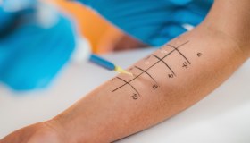 Prick test: che cos’è, come si svolge e a cosa serve