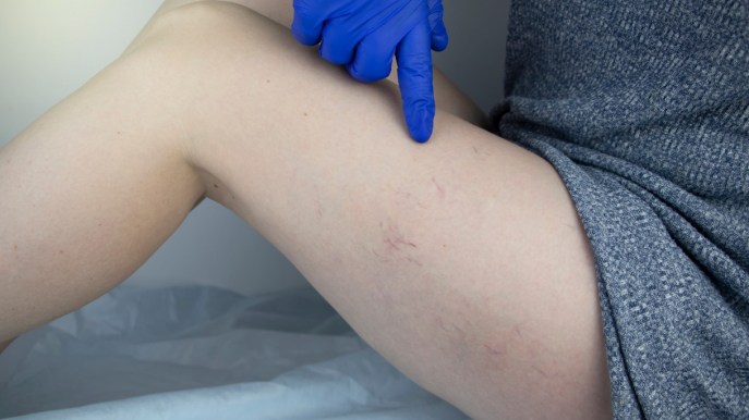 Scleroterapia per le malformazioni dei vasi sanguigni