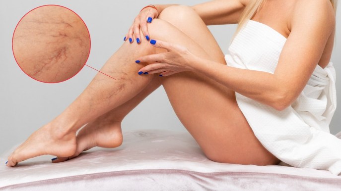 Teleangectasie: cosa sono e come si trattano
