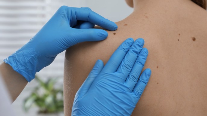 Verruche: cosa sono, cause, cura