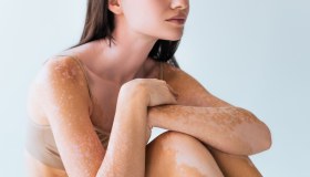 Vitiligine: tipologie, sintomi, diagnosi e cura
