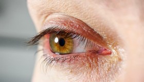 Xantelasma: cos’è, sintomi, trattamento