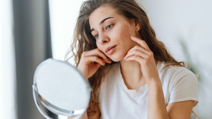 Come eliminare l’acne da stress in modo efficace