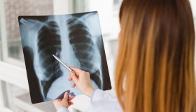 Tumore del polmone, l’immunoterapia diventa ultrarapida e si fa in 7 minuti